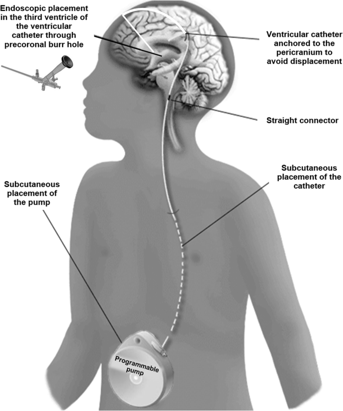 Baclofen Therapy